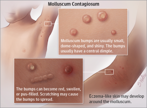 What Is Molluscum Contagiosum