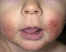 Atopic dermatitis