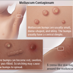 Warts and all: How to Treat Molluscum Contagiosum – Home Remedy and Treatment